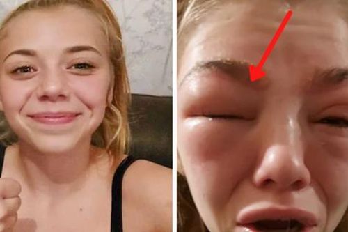 Sáng ngủ dậy, thiếu nữ khóc ngất vì mặt mày sưng vù, chảy dịch vàng, giật mình khi biết nguồn cơn là do 1 việc chị em đua nhau làm