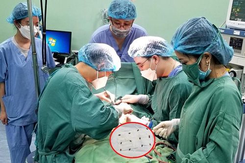 Bé trai 37 tháng tuổi, nuốt phải 25 viên bi nam châm được cấp cứu kịp thời