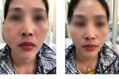 Cần Thơ: 'Tiêm má baby' bị nhiễm trùng nặng