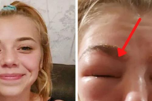 Thiếu nữ khóc ngất vì mắt sưng húp, chảy dịch sau khi nhuộm lông mày, nối mi