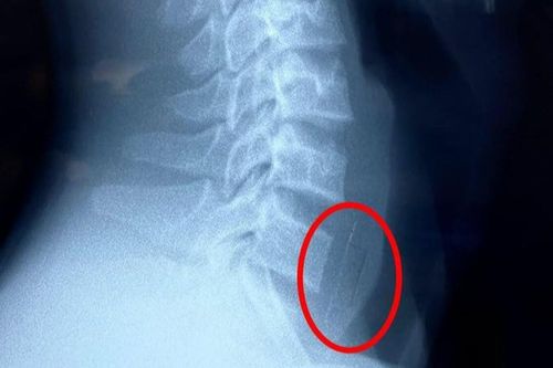 Bé trai 13 tuổi nuốt cả viên thuốc hạ sốt còn nguyên vỏ sắc nhọn