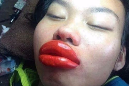 'Độ' môi xinh đón Tết, cô gái nhận về cái kết đắng, sưng tấy như ong chích