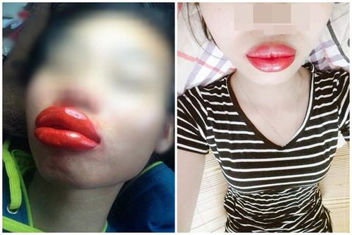 'Sang chấn tâm lý' với thảm họa phun xăm môi làm netizen ám ảnh