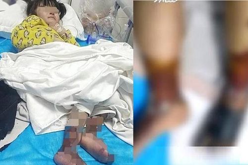 Bé gái 4 tuổi bị 'mẹ kế' rót nước sôi bỏng cả hai chân