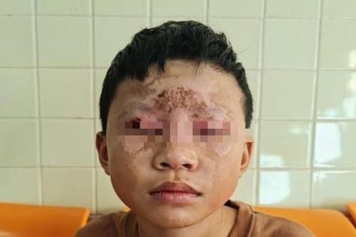 Tự chế pháo bằng diêm, bé 10 tuổi bị bỏng kín mặt