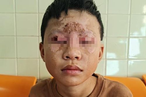 Tự chế pháo nổ theo mạng xã hội, bé 10 tuổi bị bỏng vùng mặt thương tâm