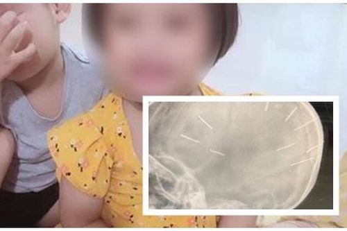 Cục Trẻ em đề nghị nhanh chóng điều tra vụ bé gái có 9 đinh ghim trong đầu