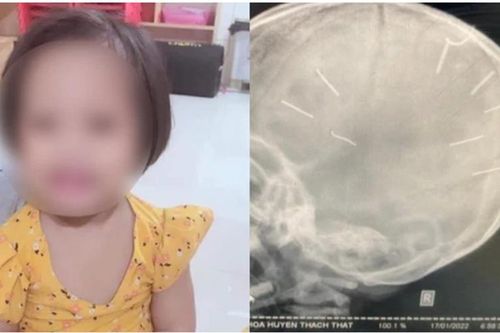 Bé gái bị 9 đinh găm vào đầu ở Hà Nội: Bác sĩ nói gì?