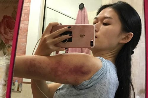 Một sao nữ 'bầm mình' vì giảm cân sai phương pháp