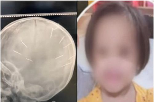 Vì sao gã 'cha dượng' đóng đinh đầu bé 3 tuổi ở Hà Nội?
