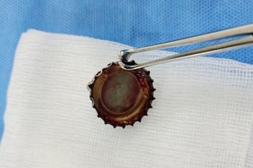 Nắp chai nước giải khát cắm sâu trong thực quản nam thanh niên