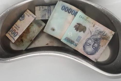 Hy hữu: Mâu thuẫn gia đình, người phụ nữ nuốt 12,5 triệu đồng vào bụng