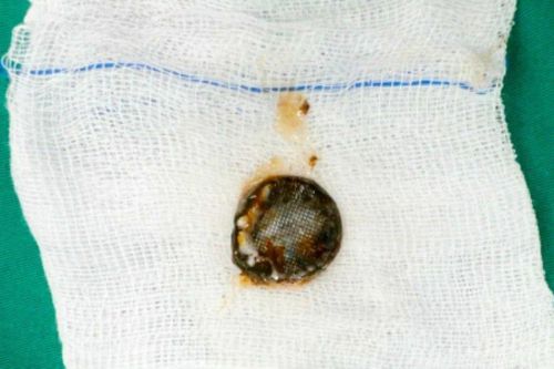 Bé trai bị bỏng thực quản do nuốt pin