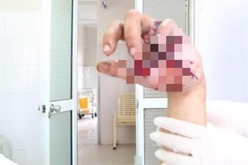 Thiếu niên bị nát bàn tay, lộ xương vì pháo tự chế