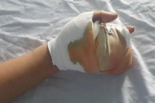 Cấp cứu khẩn thiếu niên bị dập nát bàn tay vì pháo tự chế