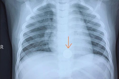 Cứu sống bé trai 5 tuổi mắc dị vật pin cúc áo, bác sĩ đưa ra lời khuyên đáng lưu ý cho bố mẹ