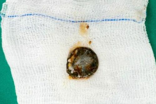 Bé trai 5 tuổi bị bỏng thực quản vì nuốt pin cúc áo