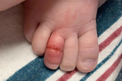 Bé trai 5 tháng tuổi tại Mỹ suýt mất ngón chân vì một sợi tóc