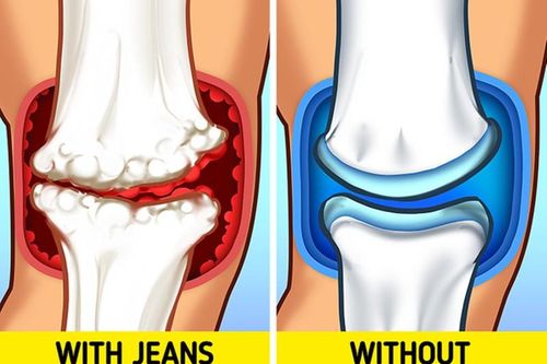 Diện jeans bó sát, người mặc khổ vì 'phá' dáng, 'đầu độc' sức khỏe
