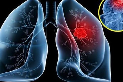NSƯT Tiến Hợi qua đời vì ung thư phổi: 4 dấu hiệu dễ nhận biết nhất nhưng rất dễ bị bỏ qua