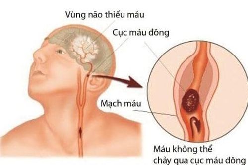 Vì sao cần theo dõi rối loạn đông máu ở người nhiễm Covid-19?