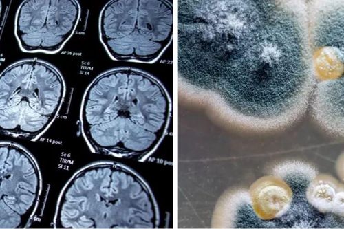 Thanh niên trẻ bị mốc đen mọc thành mảng trong não