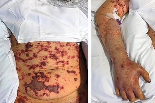 Mất chân sau khi ăn mì thừa của bạn cùng phòng