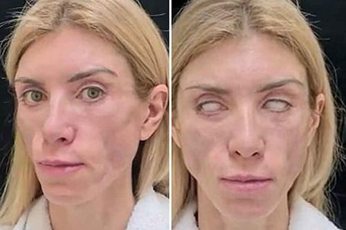 Mắt cựu Á hậu Nga bỗng trợn trừng không nhắm được, căn nguyên là do 1 việc chị em đua nhau làm