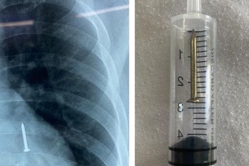 Đinh thép dài 3cm 'đi lạc' trong phế quản một công nhân