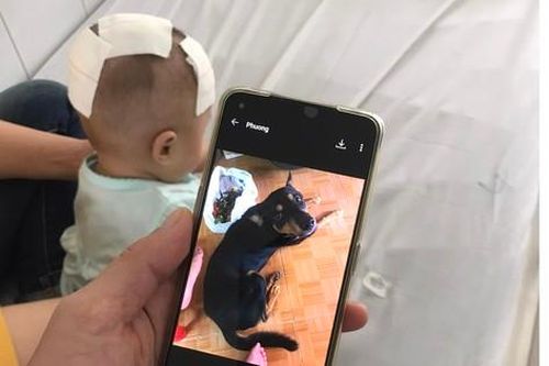 Cấp cứu thành công bé gái bị chó cắn xuyên sọ