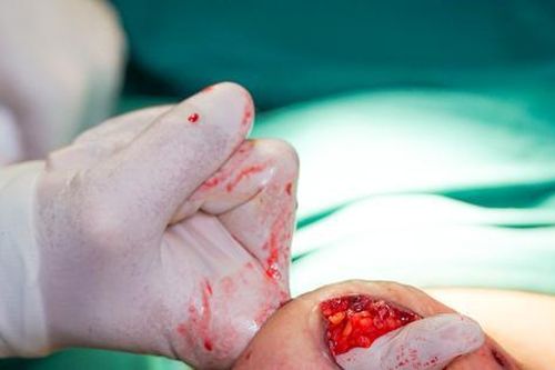 Tự tiêm thuốc tan mỡ, bụng bệnh nhân hoại tử trào mủ như 'núi lửa'