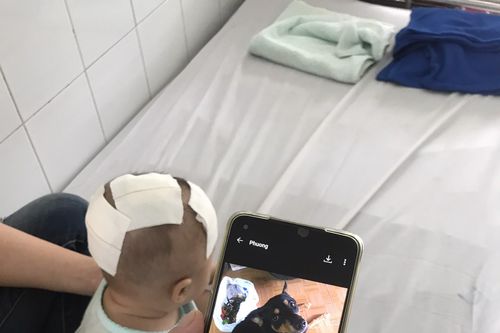 Cấp cứu kịp thời bé gái bị thú cưng cắn xuyên sọ