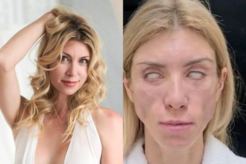 Nàng Á Hậu nghiện PTTM rồi gánh chịu hậu quả mặt cứng đơ, mắt trợn ngược
