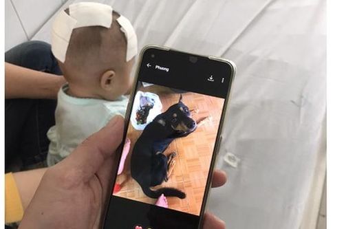 Cứu sống bé gái 6 tháng tuổi bị chó nhà cắn chấn thương sọ não