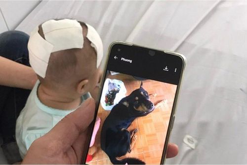 Xót xa bé gái 6 tháng tuổi bị chó cưng cắn xuyên xương sọ