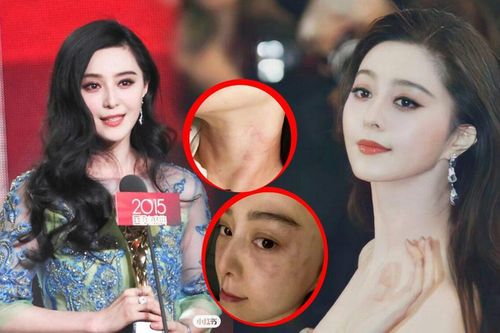 Phạm Băng Băng lộ vết bầm đen khắp cổ, mặt sưng húp, khiến fan lo lắng