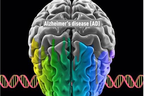 Phát hiện mới về nguyên nhân gây bệnh Alzheimer