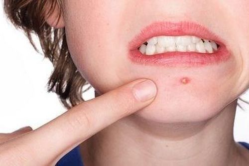 Đừng chủ quan khi mụn nhọt xuất hiện