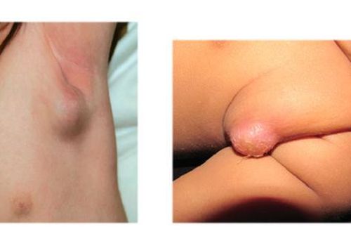 Trẻ bị viêm hạch bạch huyết sau tiêm ngừa lao có đáng lo?