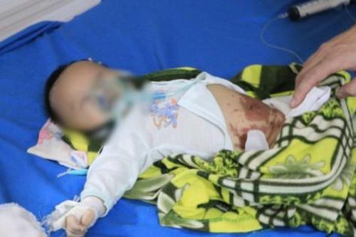 Trẻ 2 tháng tuổi co giật, tím tái do đắp tỏi điều trị COVID-19