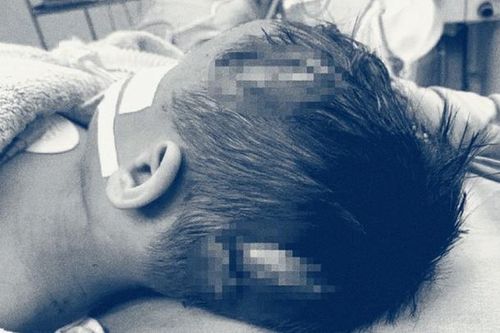 Bé trai 31 tháng tuổi bị chó tấn công vào đầu phải nhập viện