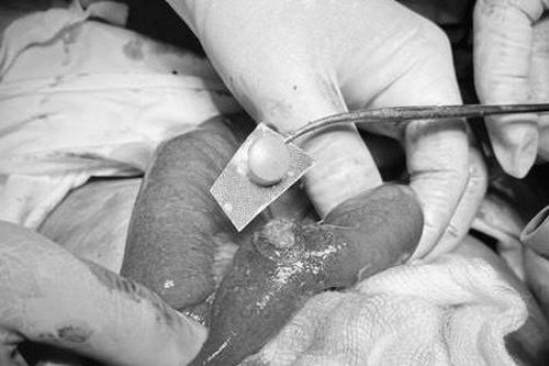 F0 thủng ruột vì uống cả vỏ thuốc vào bụng