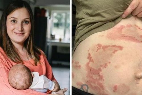 Sản phụ dị ứng trầm trọng với chính con đẻ của mình