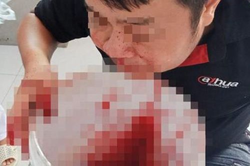 Hy hữu: Chảy máu mũi ồ ạt, chàng trai bưng xô hứng cầu cứu bác sĩ may mắn thoát chết