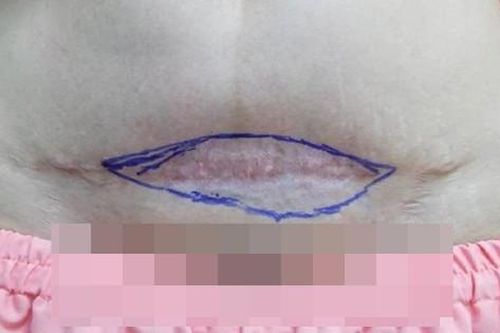 Một phụ nữ Hà Nội bị teo da bụng vì tiêm tan sẹo tại spa
