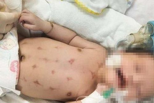 Mời thầy lang đến chích đẹn, bé 16 ngày tuổi nguy kịch