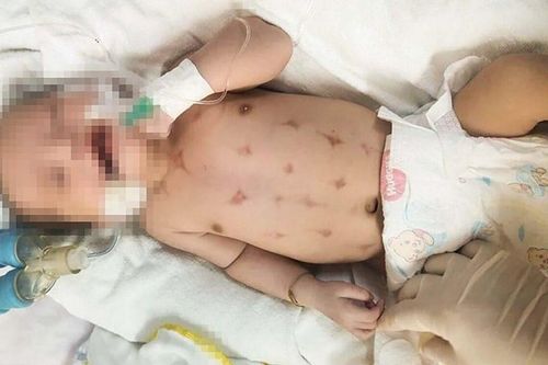 Bé 16 ngày tuổi nguy kịch sau khi được thầy lang 'lể đẹn'