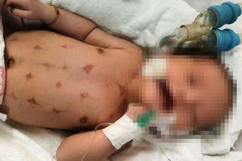 Bé 16 ngày tuổi phải cấp cứu vì nhờ thầy lang làm lễ đẹn