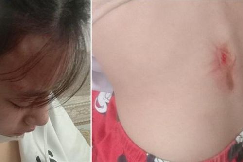 Điều tra vụ nữ sinh lớp 10 bị đánh chấn động não