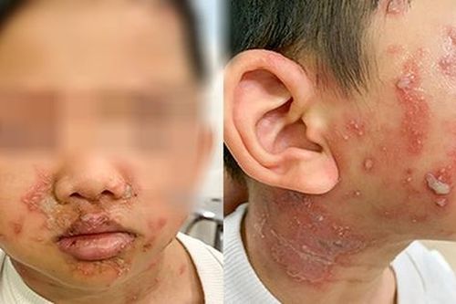Trẻ 5 tuổi bị kiến ba khoang cắn, bác sĩ cảnh báo những nguy hiểm